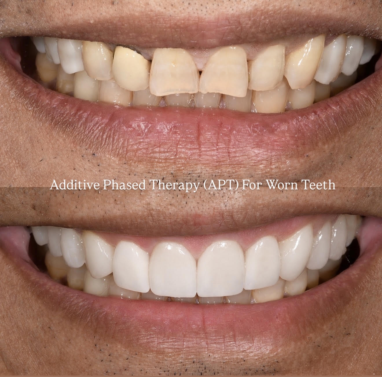 Additive phased therapy for worn teeth before and after