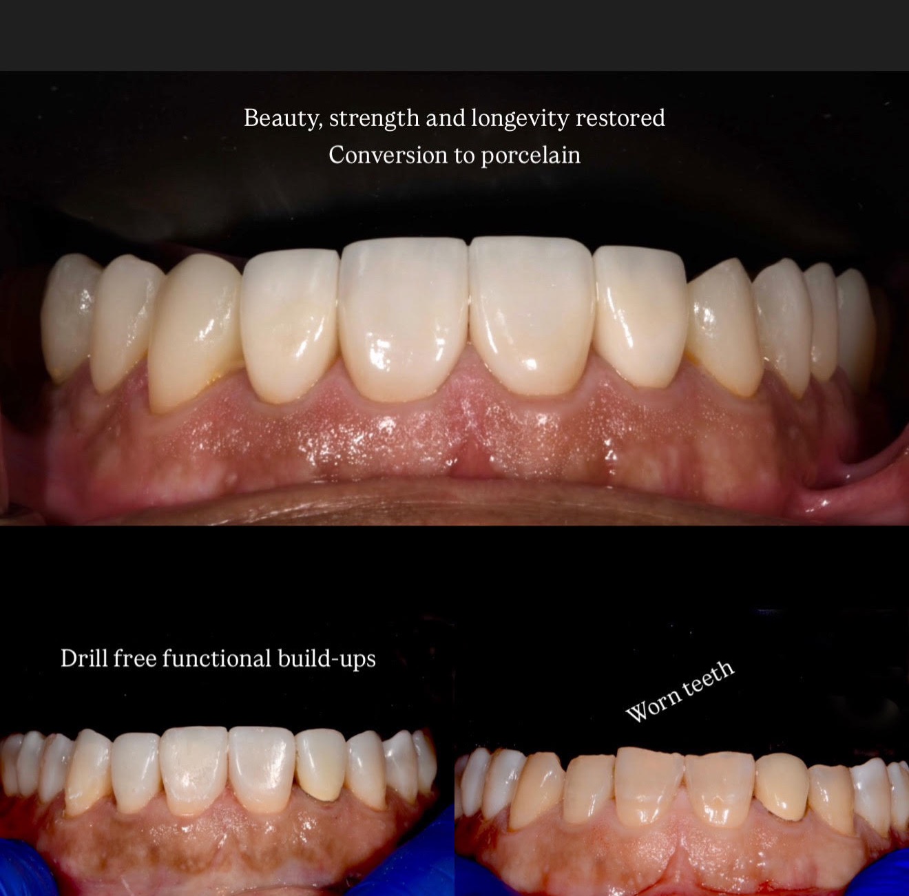 Additive phased therapy for worn teeth with conservative bite reconstruction