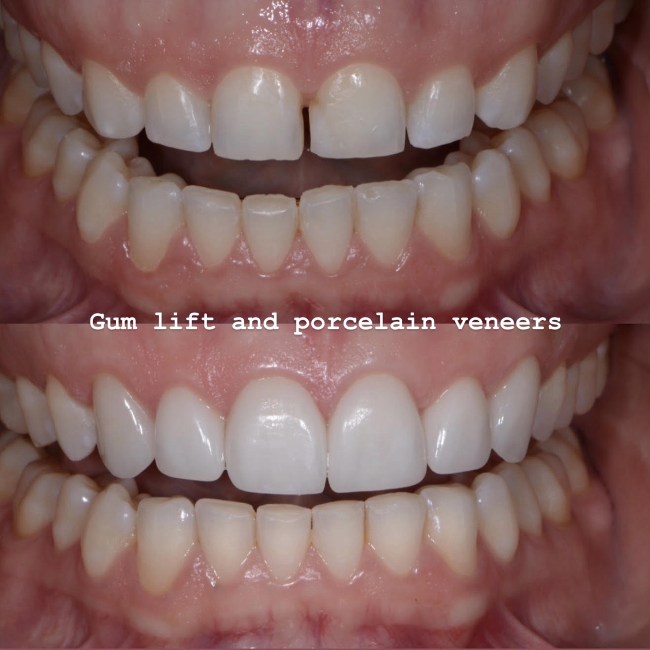 Before and after of a conservative gum lift and hand-layered porcelain veneers designed for balanced tooth proportions