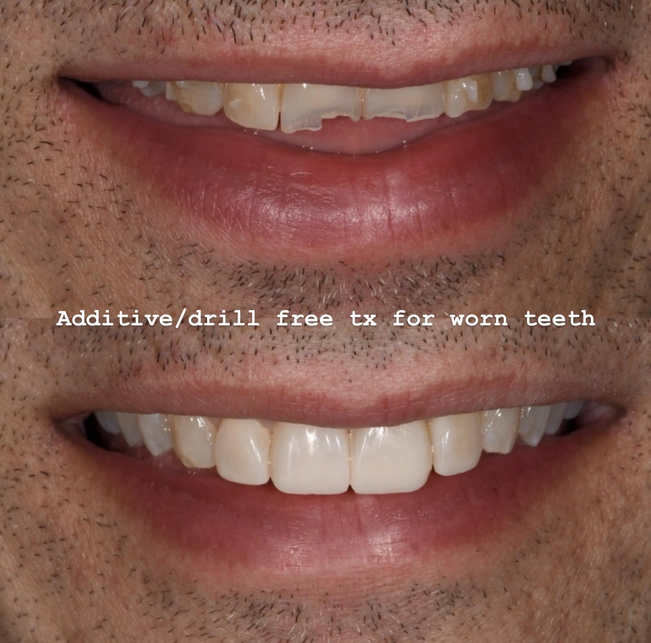 Worn teeth before additive direct resin veneer treatment