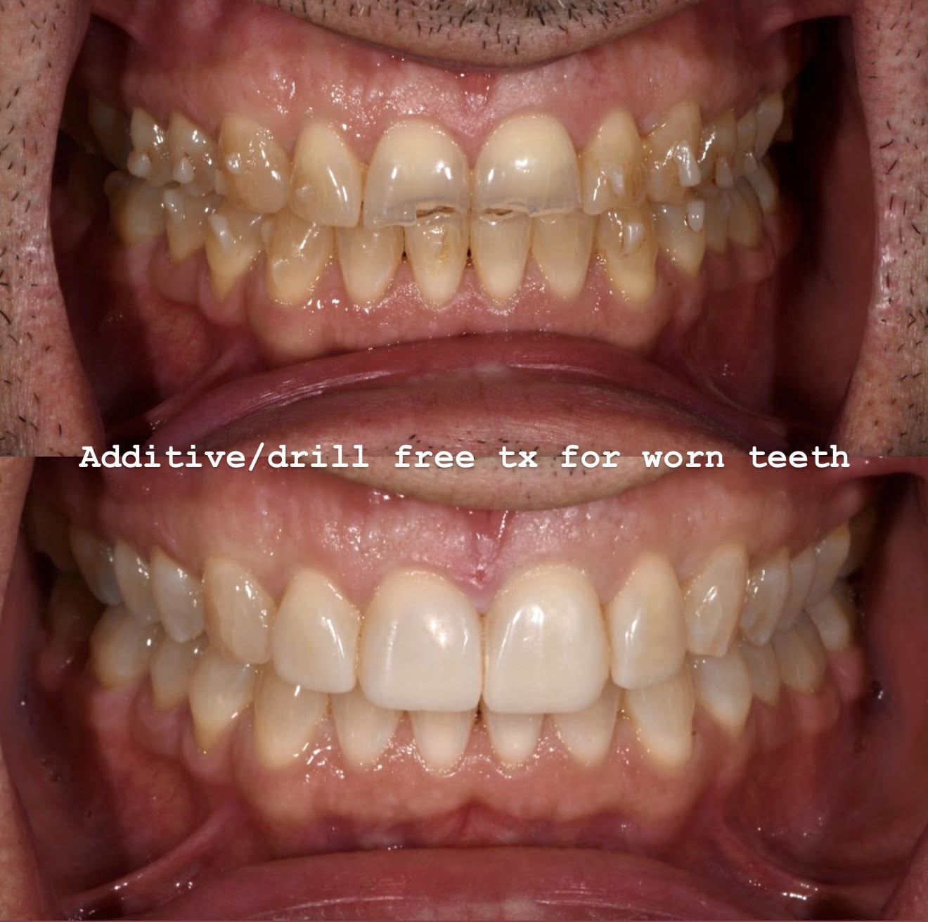 Drill-free additive resin veneers after aligner therapy for worn teeth