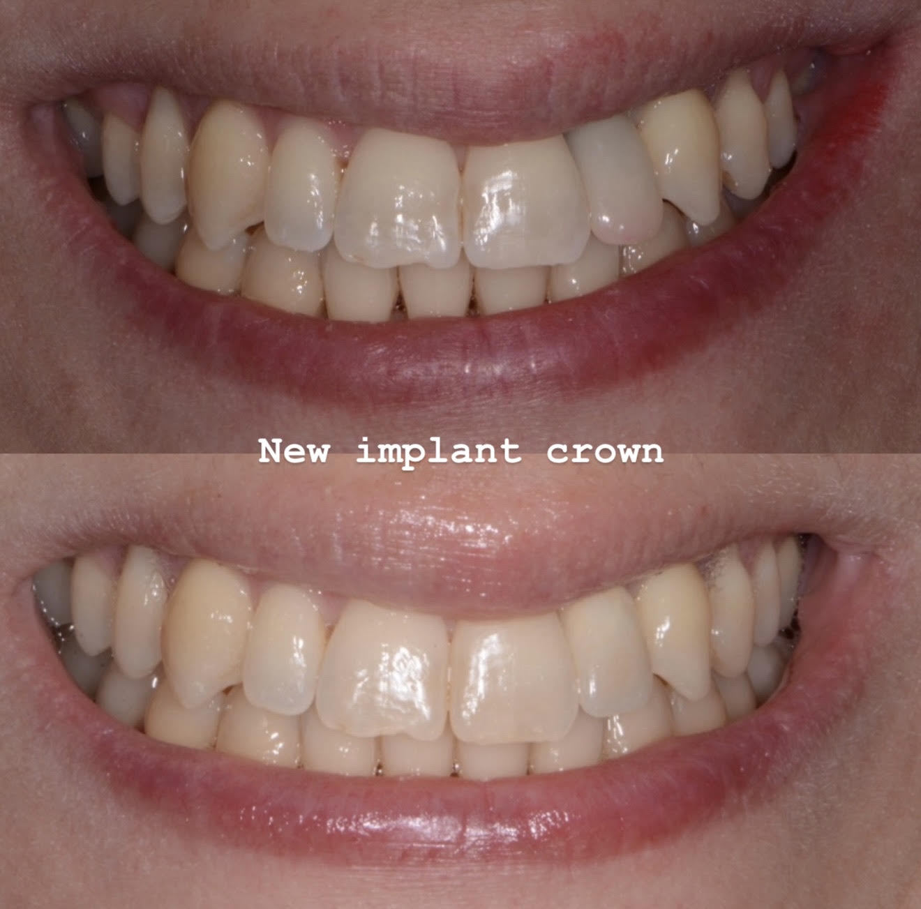 Implant crown case showing fitting and functional but less esthetic crown design
