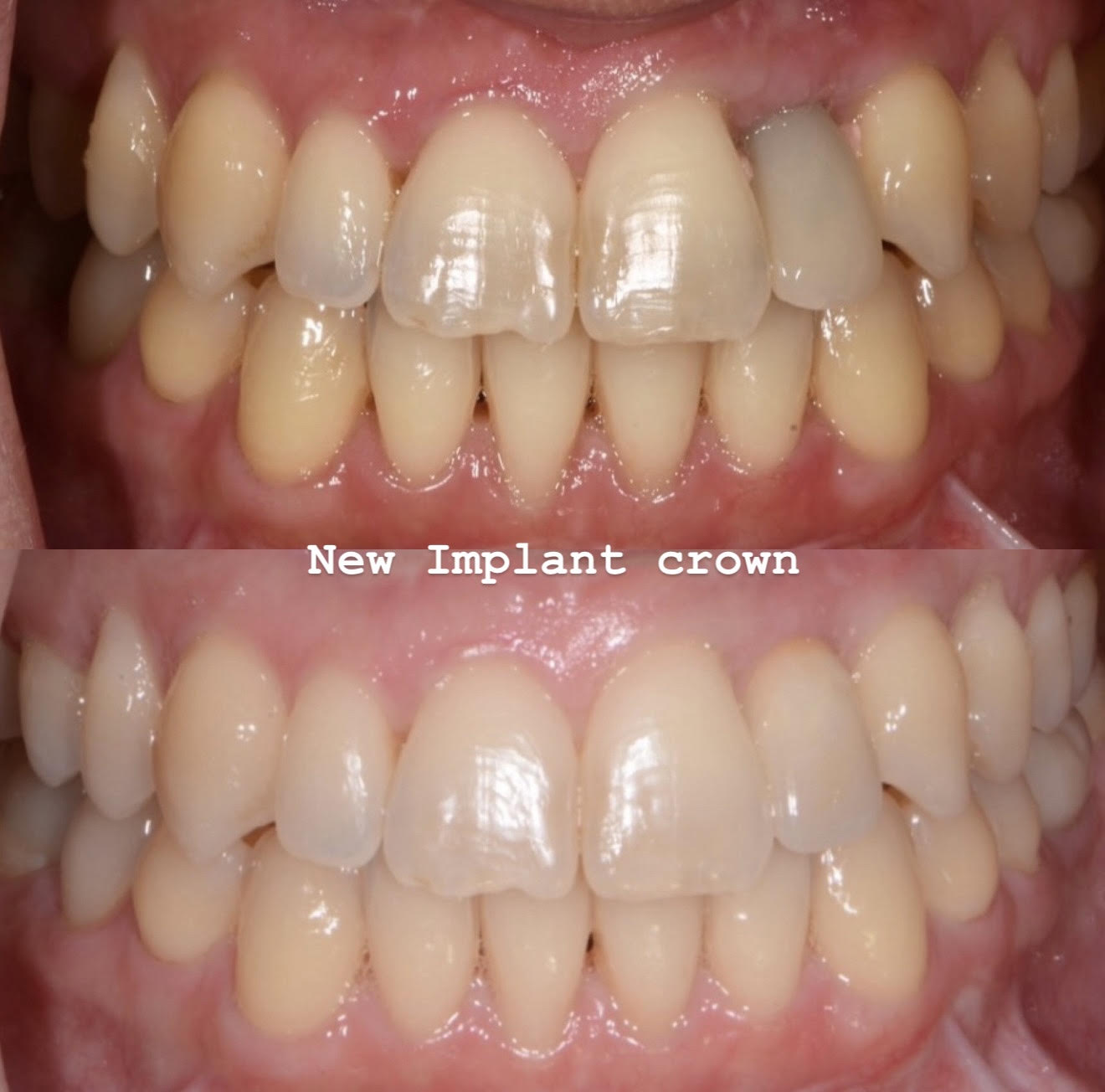 Esthetic implant crown designed to harmonize with gingiva, lips, and neighboring teeth
