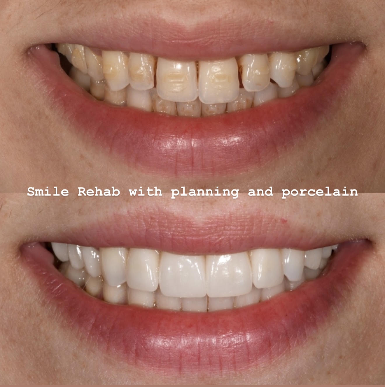 Before and after smile view of foundation-first rehabilitation with orthodontic alignment and porcelain veneers