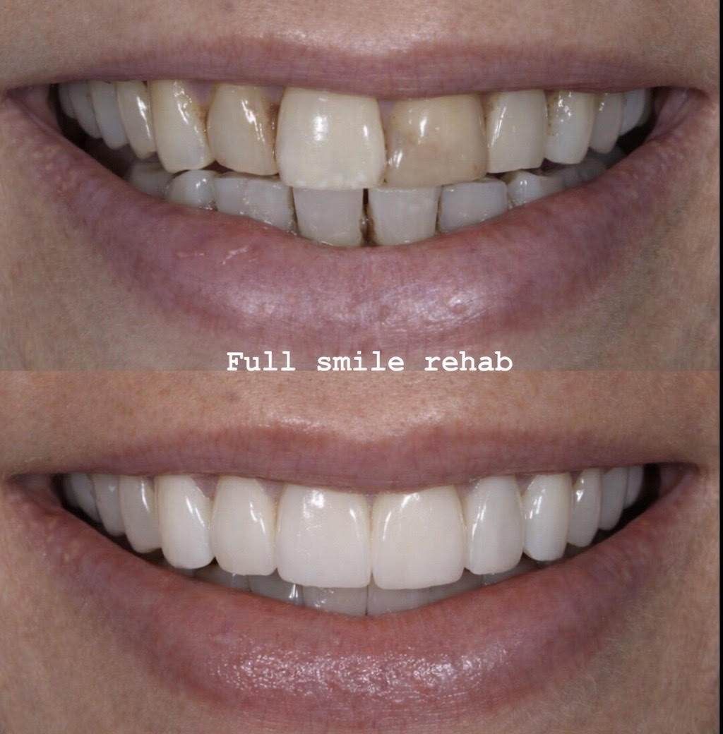 Full Smile Rehabilitation
