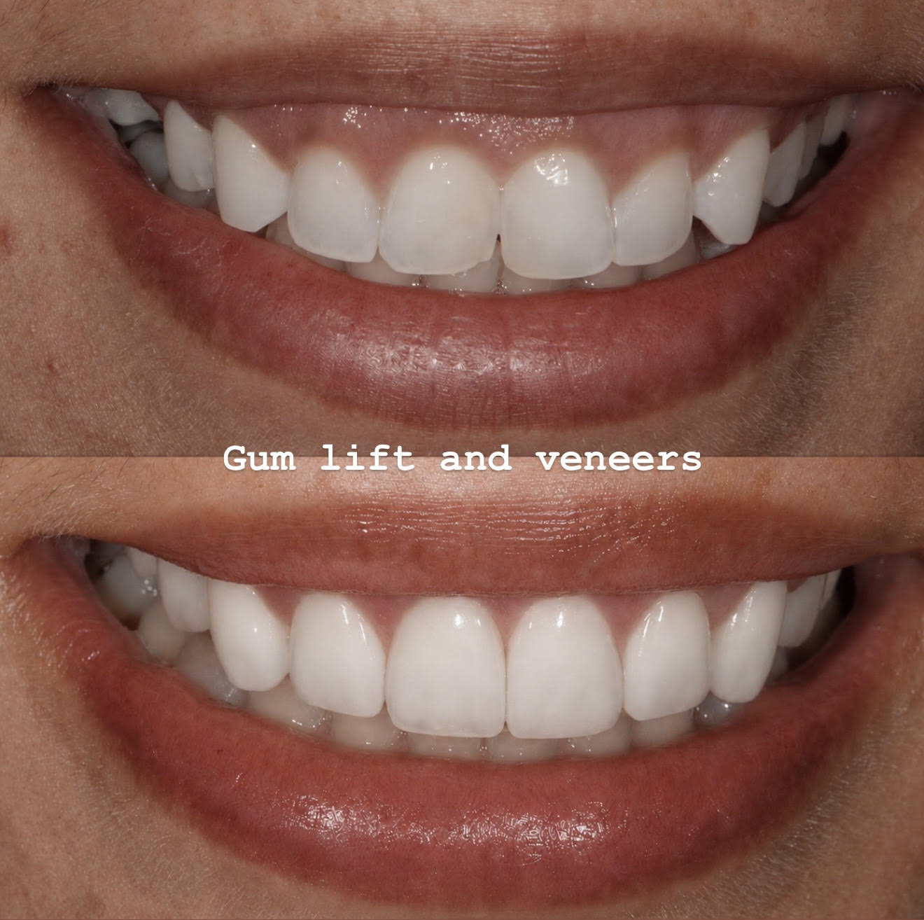 Gum Lift and Veneers