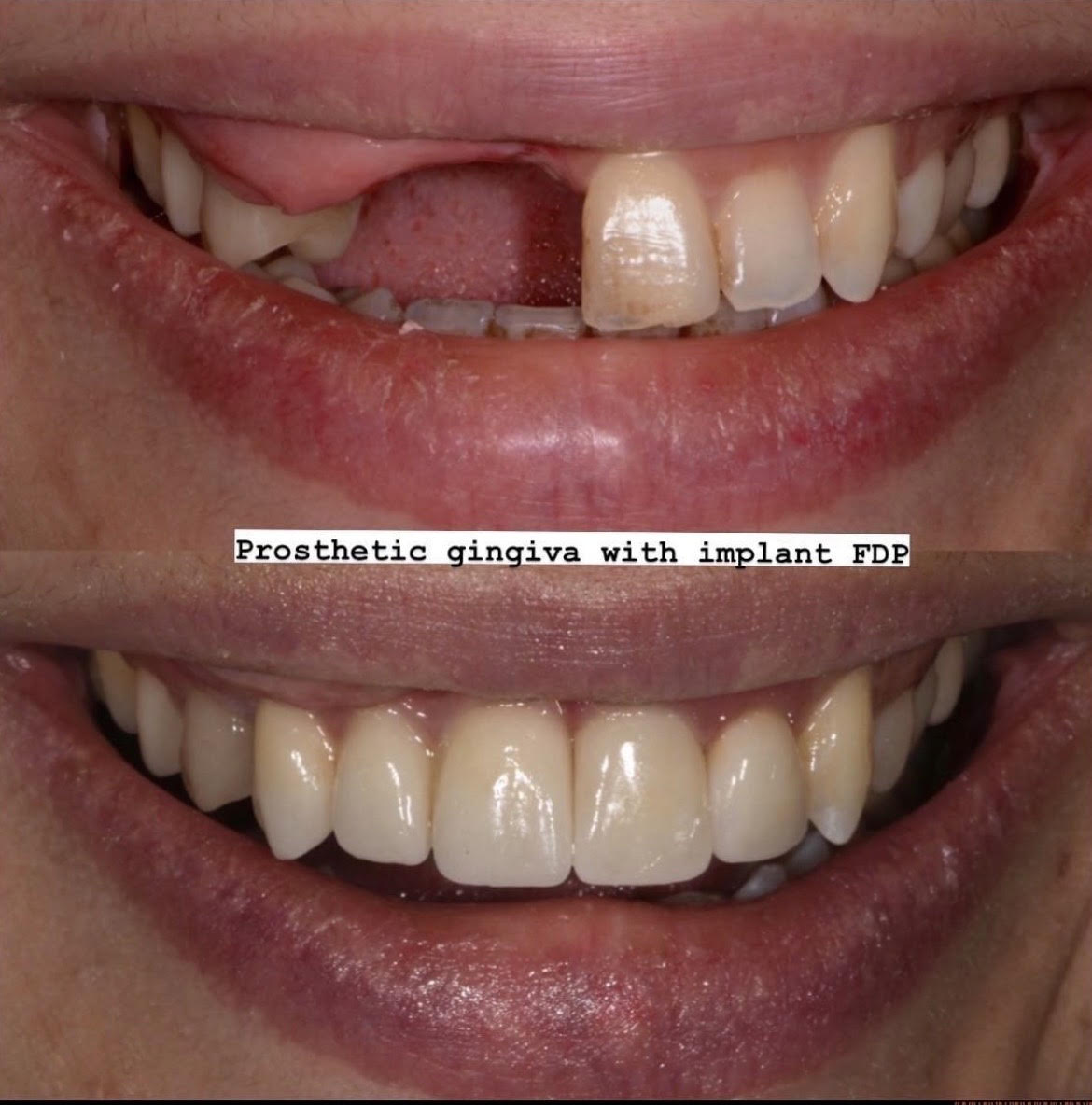 Implant Esthetics
