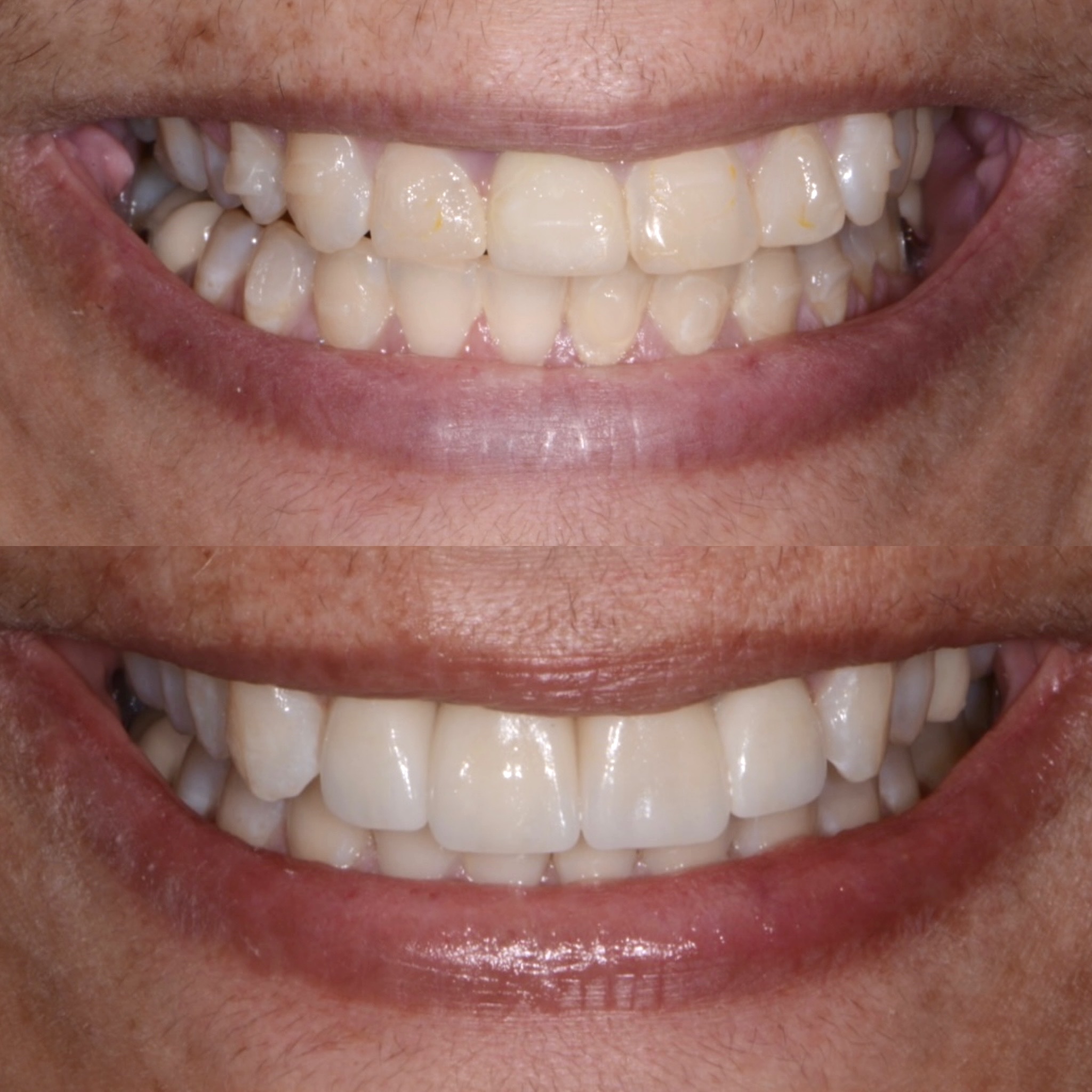 Implant crown and porcelain veneers smile makeover