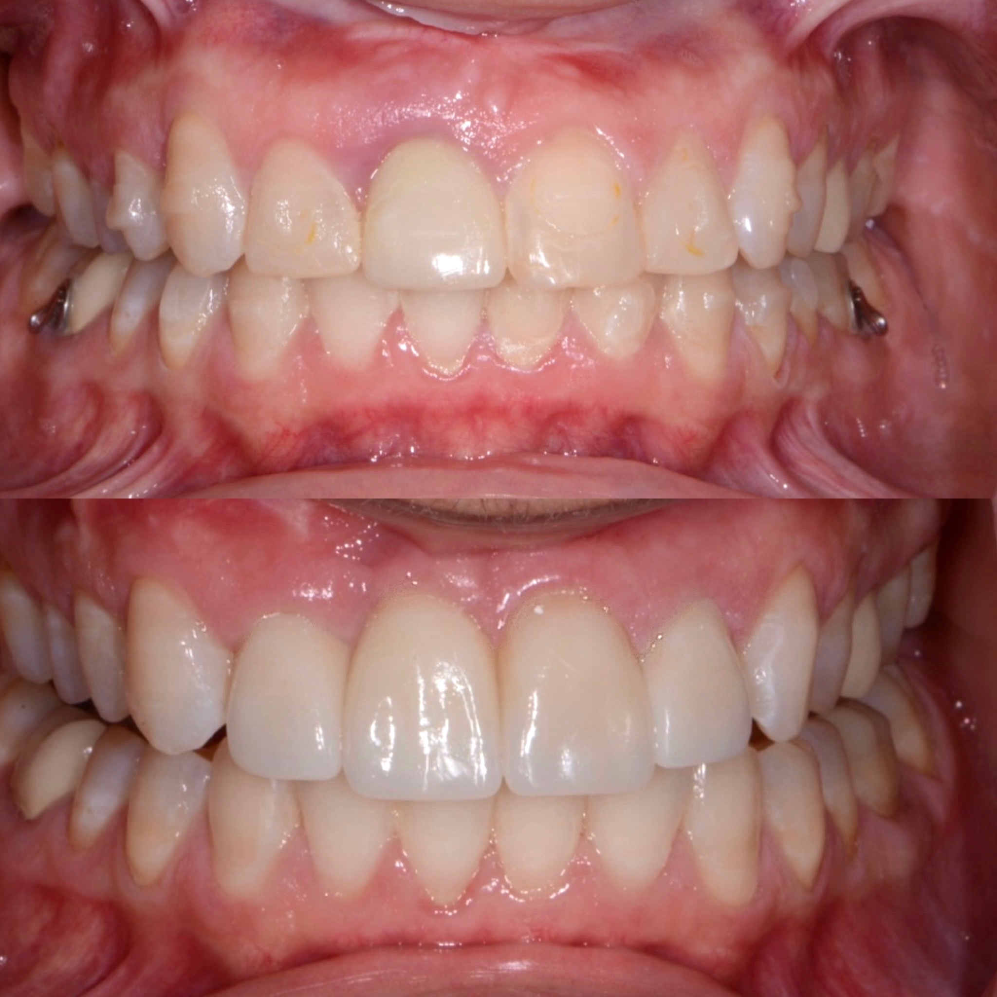 Natural implant crown and bespoke porcelain veneers smile makeover