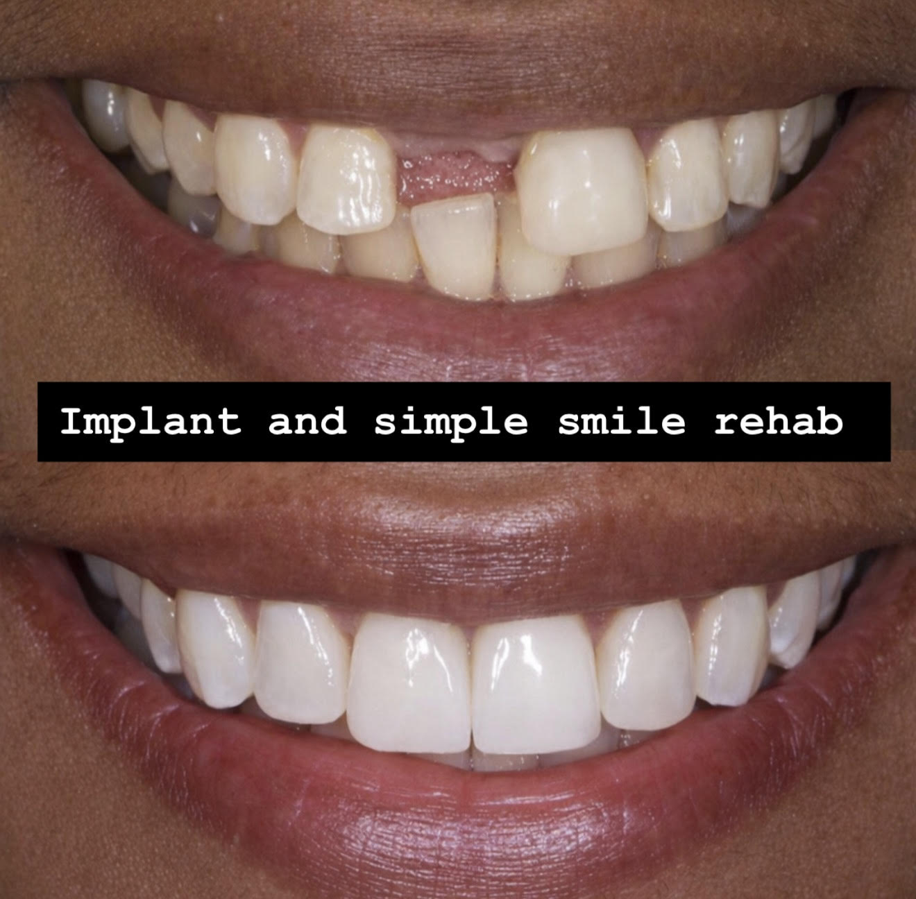 Implant Smile Rehabilitation