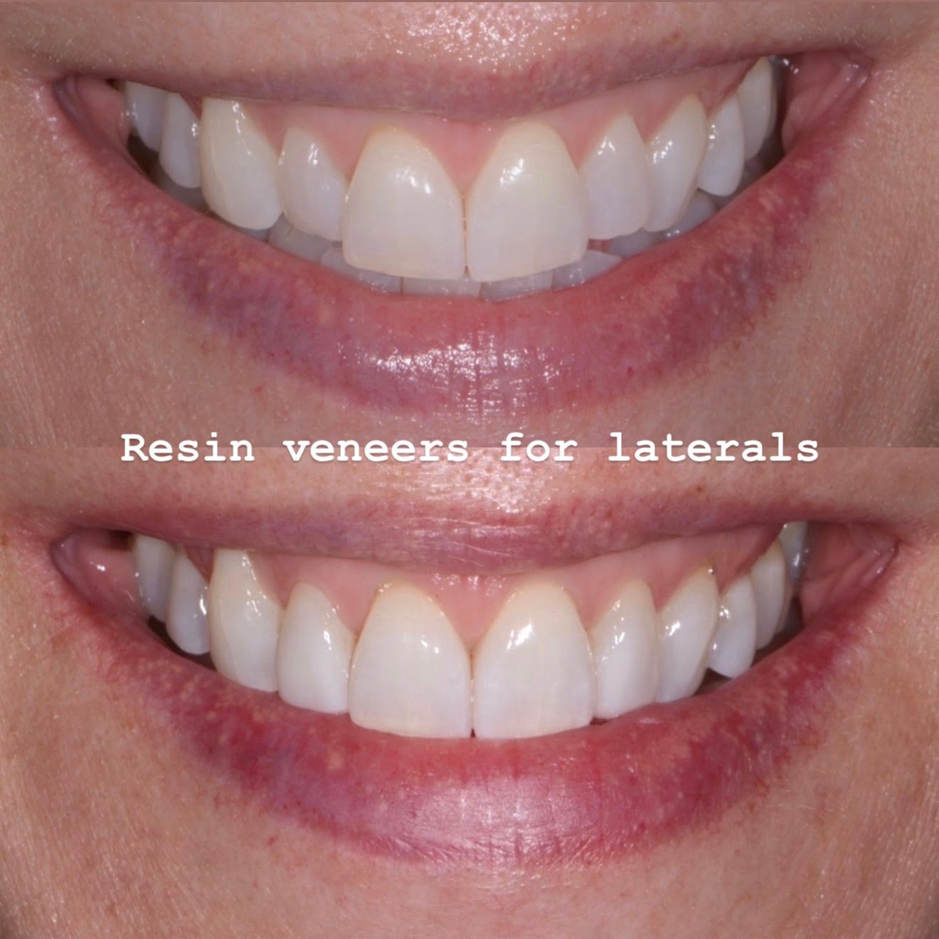 Before and after smile view of no-prep additive resin veneers correcting recessed lateral incisors