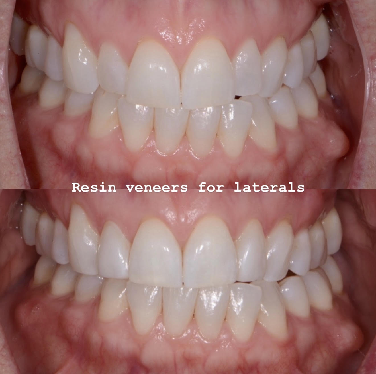 Retracted before and after view of additive resin veneers improving lateral incisor size, color, rotation, and alignment