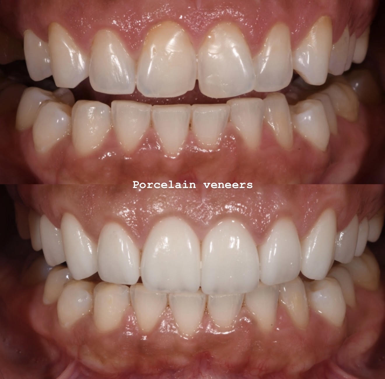Before and after of luminous layered porcelain veneers with an implant crown restoring the upper-right bicuspid