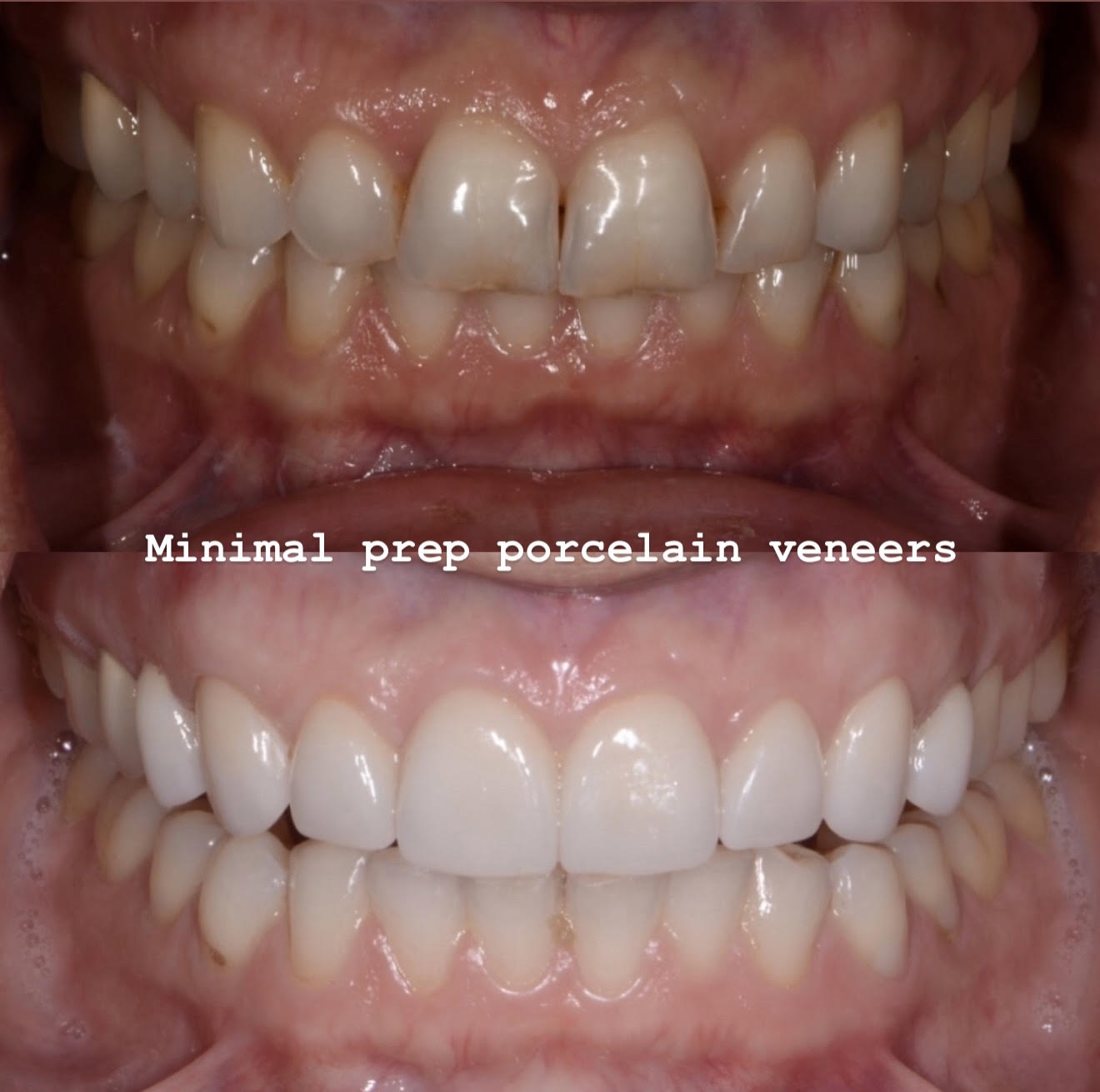 Minimal-preparation porcelain veneers preserving tooth structure and supporting gingival architecture