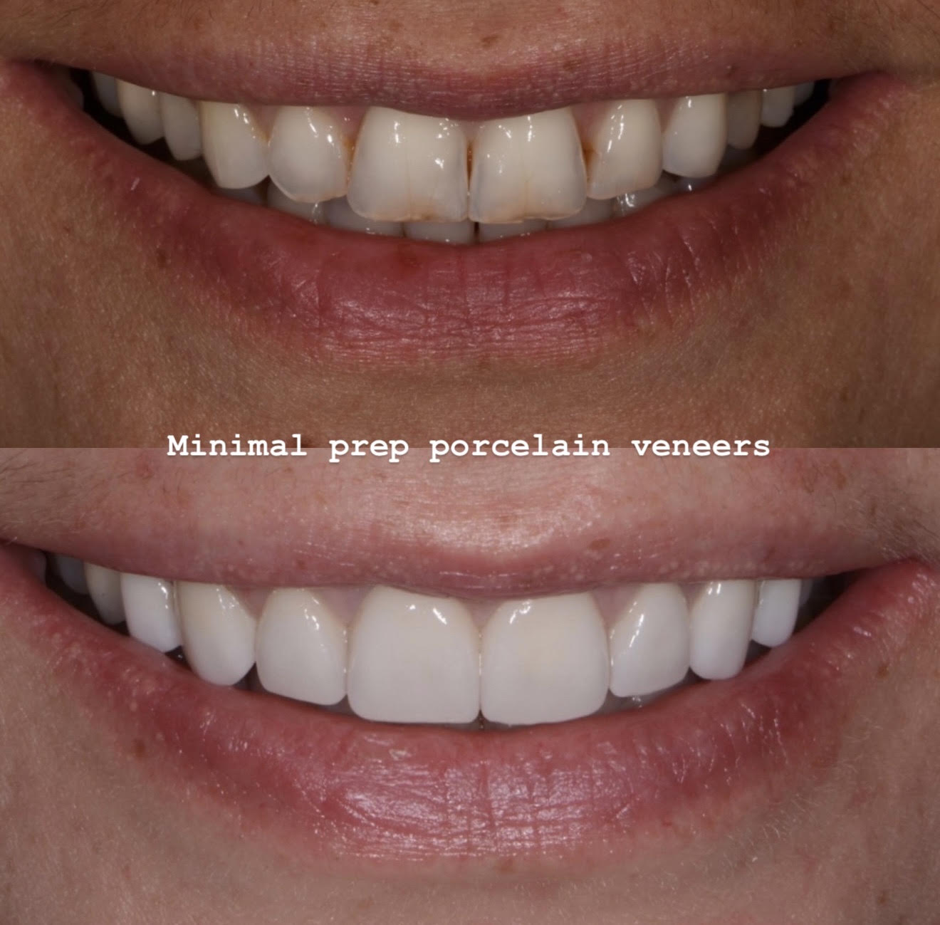 Minimal-preparation veneers with healthy gingival framing and harmonious smile design