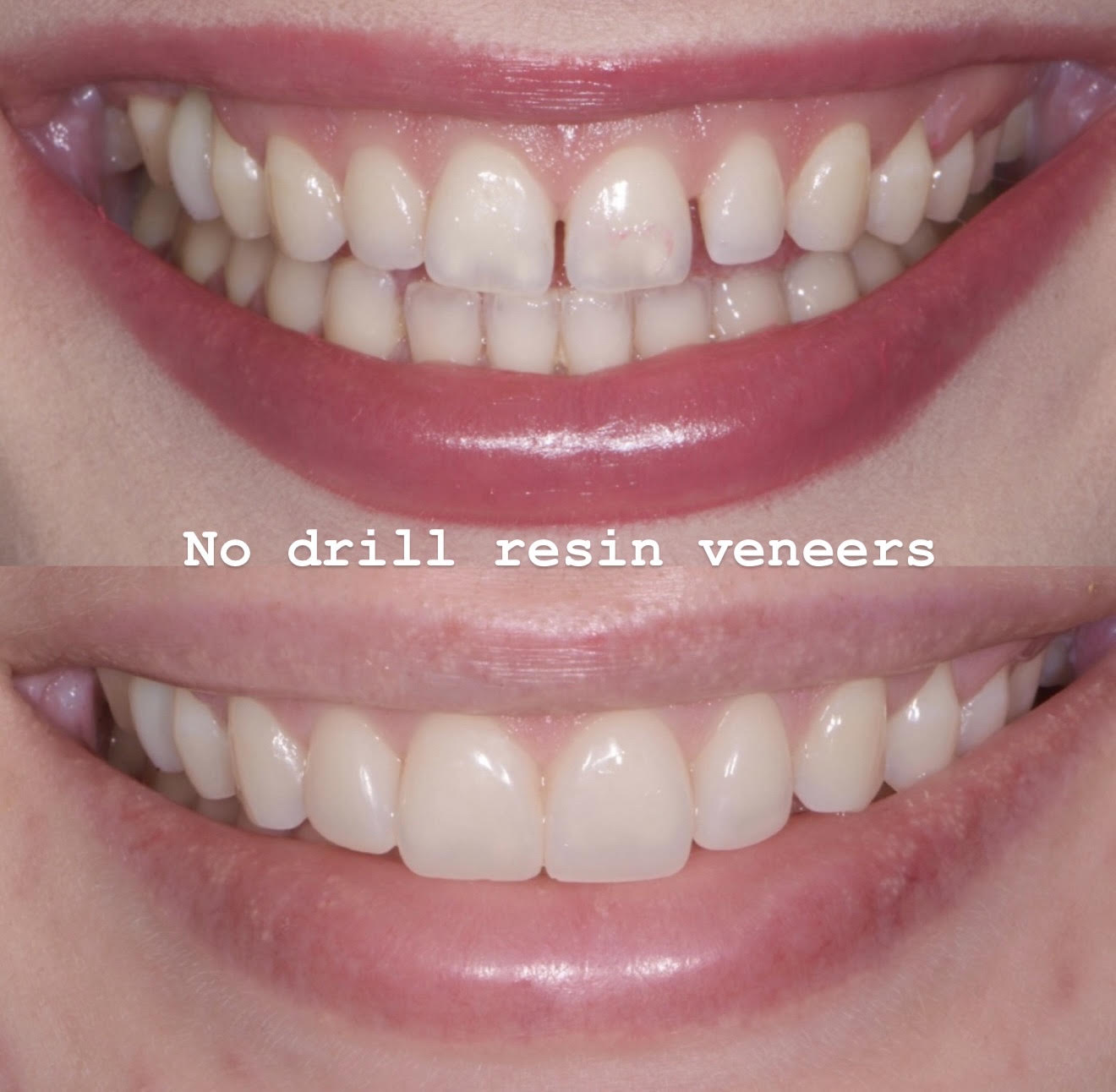 No-drill resin veneers smile enhancement