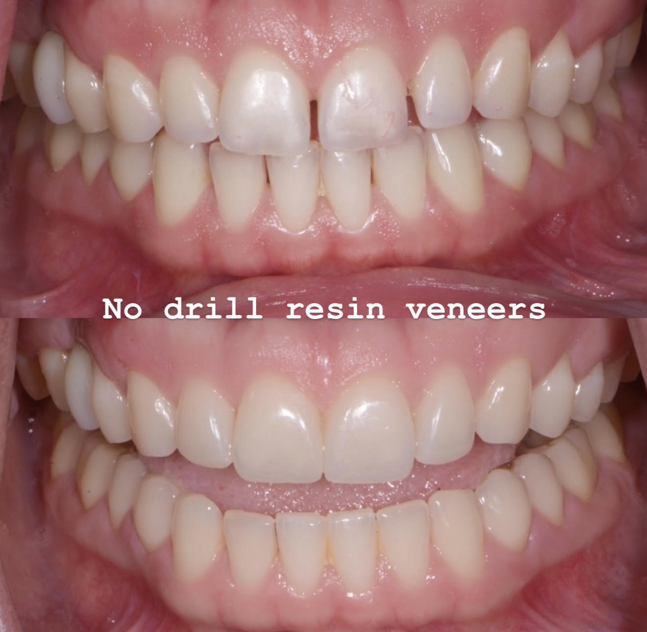 Minimally invasive no-drill resin veneers