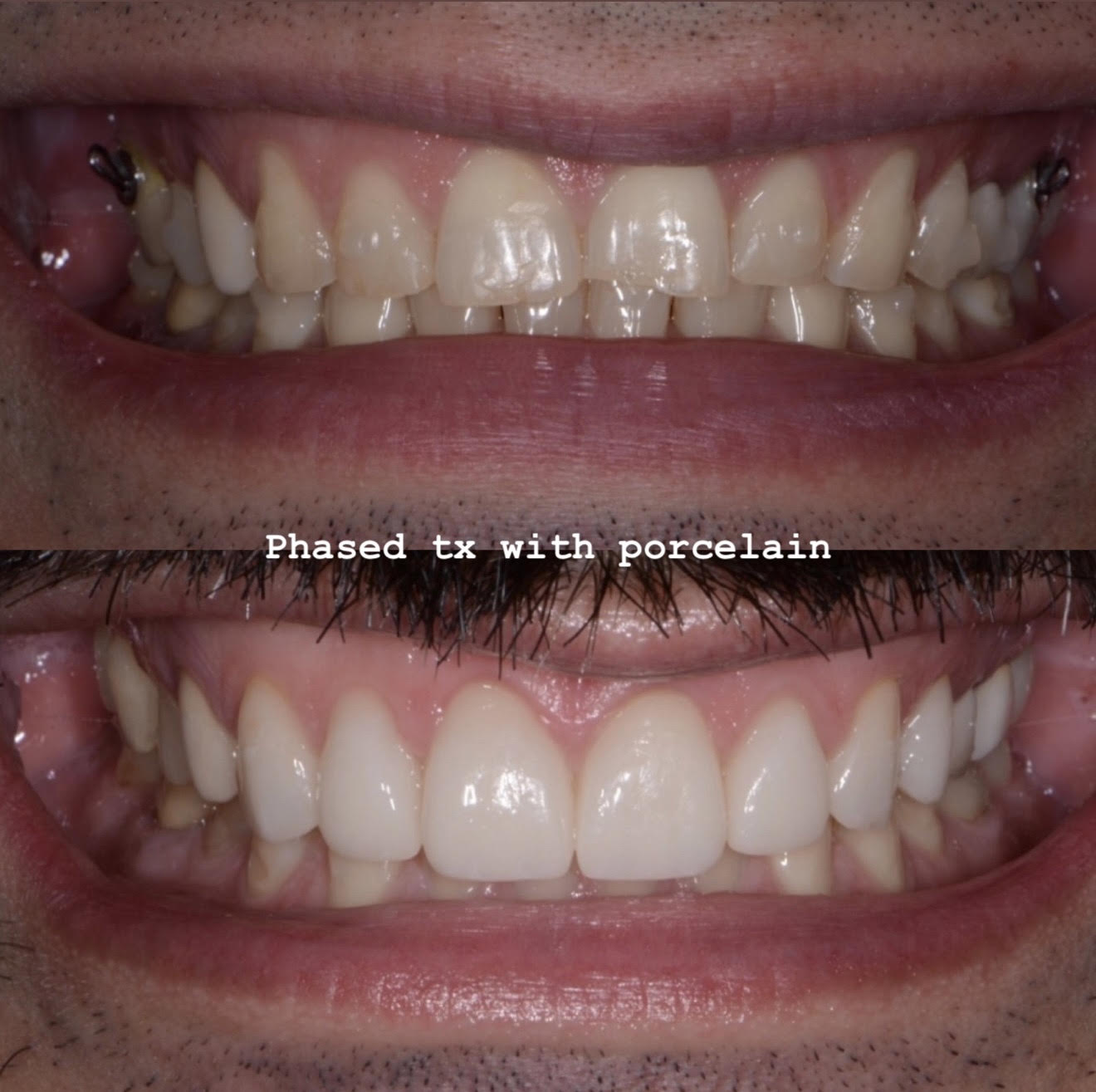 Full-smile before and after of phased treatment for worn dentition with in-house porcelain veneers