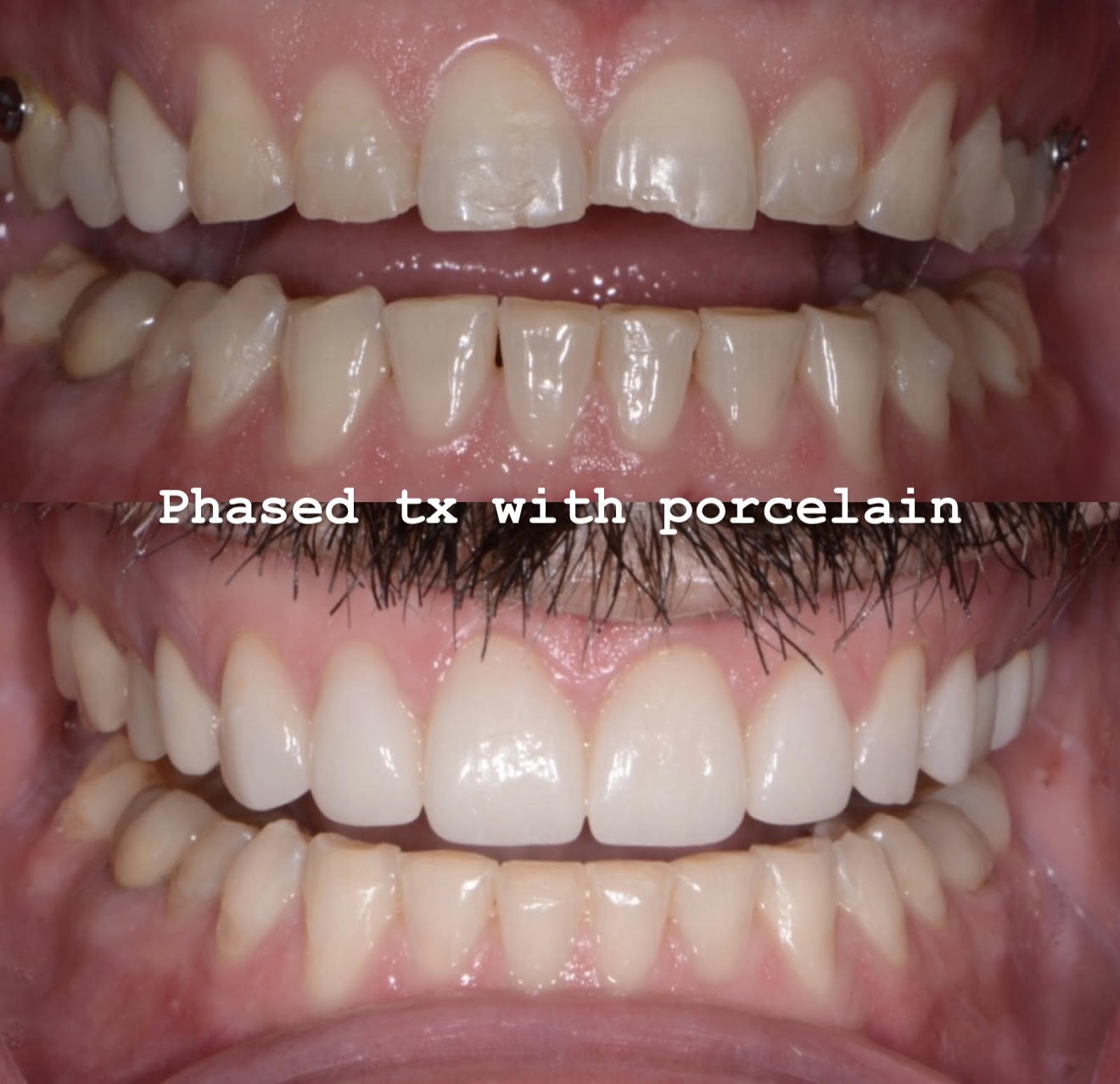Retracted before and after of worn dentition restored with phased in-house porcelain veneers