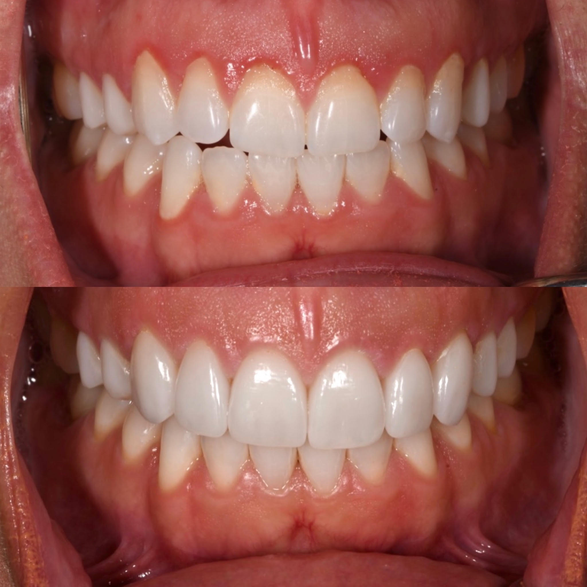 Close-up before and after showing handcrafted porcelain veneers and refined smile proportions