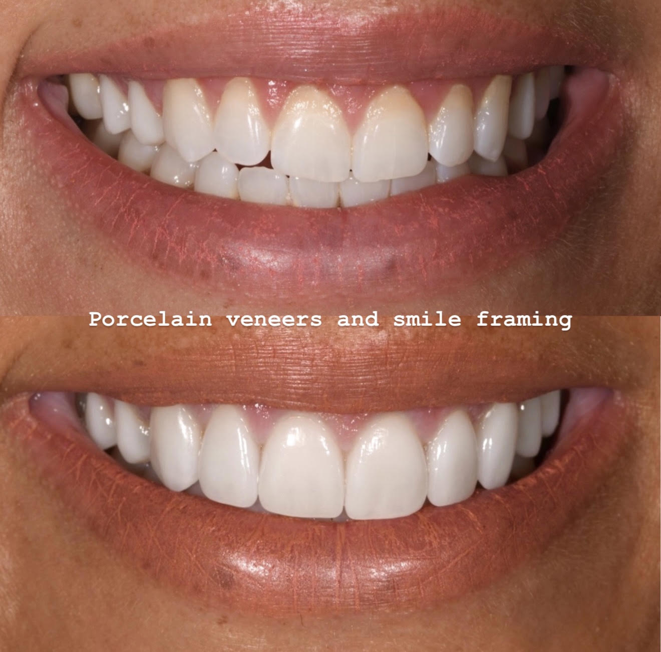 Before and after showing handcrafted porcelain veneers framed harmoniously by the patient’s lips and face