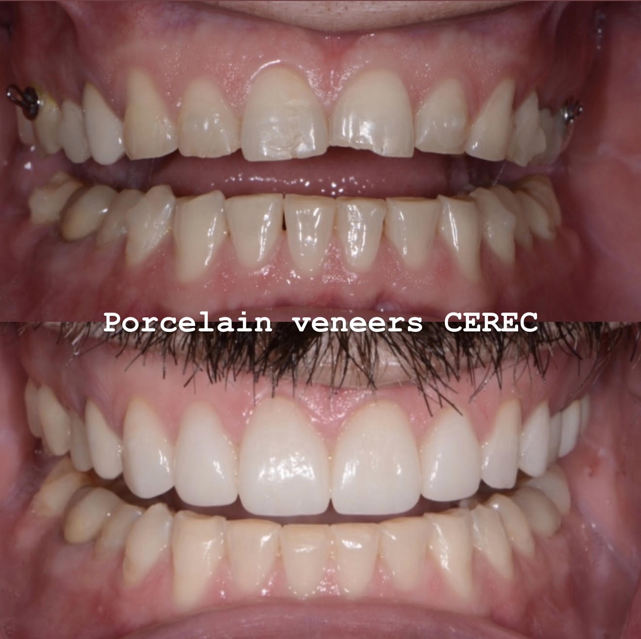 Porcelain veneers with CEREC esthetic dentistry