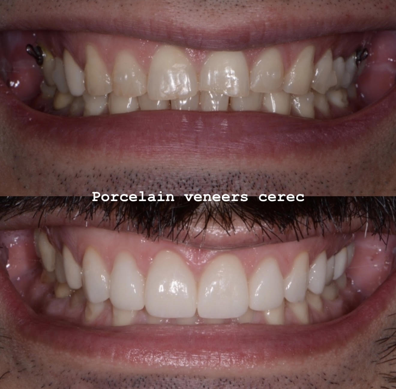 Porcelain veneers with CEREC smile transformation