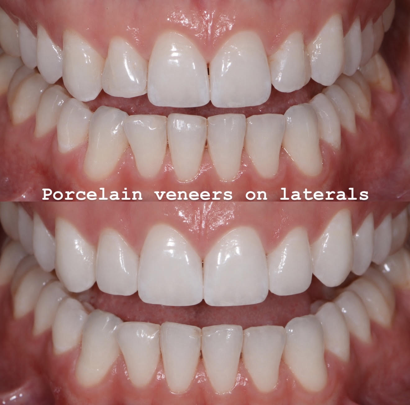 Porcelain veneers on lateral incisors