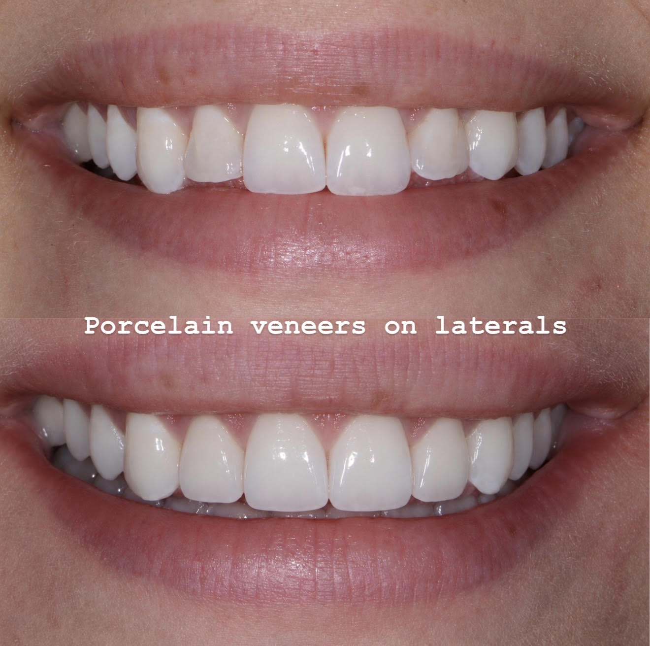 Porcelain veneers on lateral incisors smile transformation