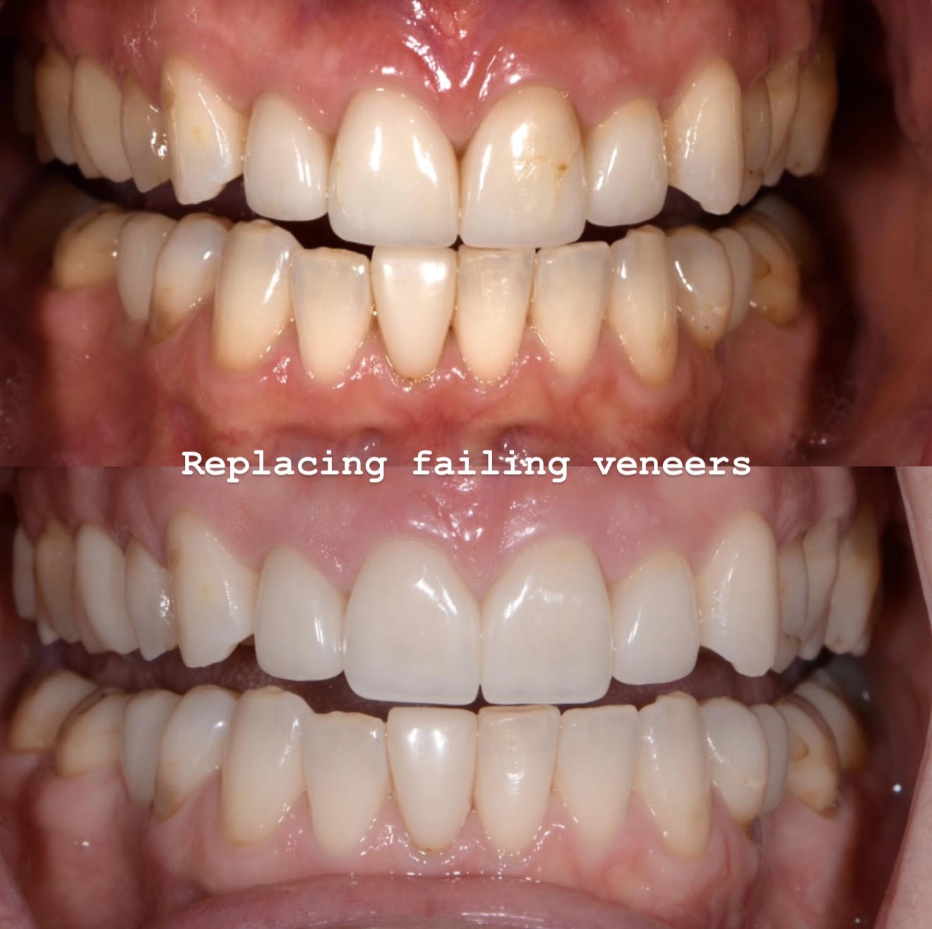 Smile transformation after replacing failing veneers