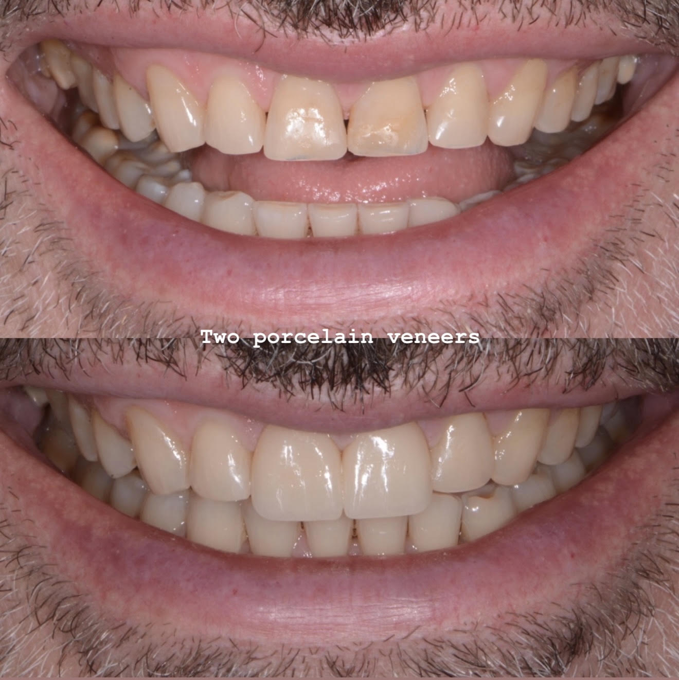 Two porcelain veneers with minimal bonding: before and after smile close-ups show more even edges and a more uniform shade on the two upper front teeth in the lower photograph.