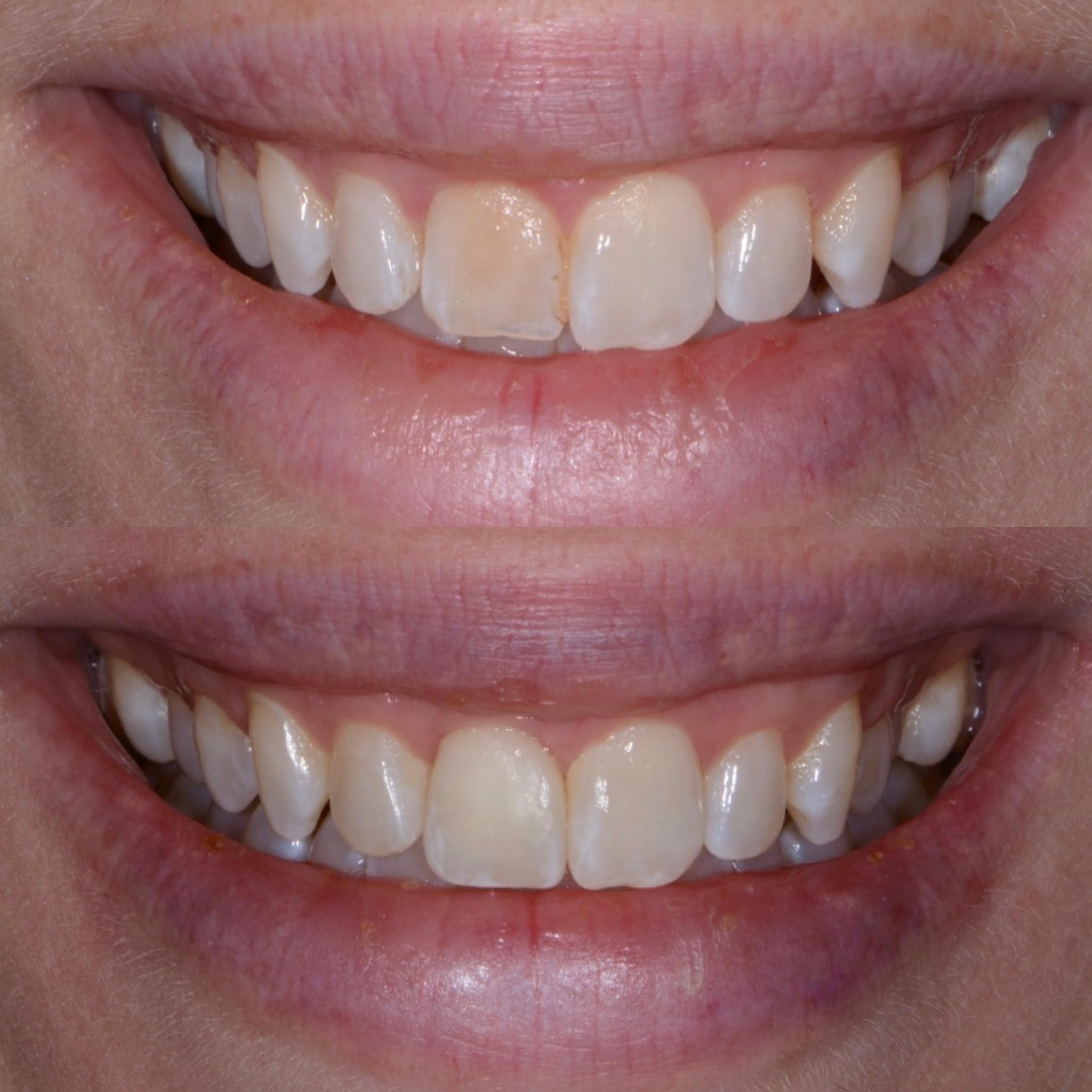 Single-tooth implant crown matched to natural dentition