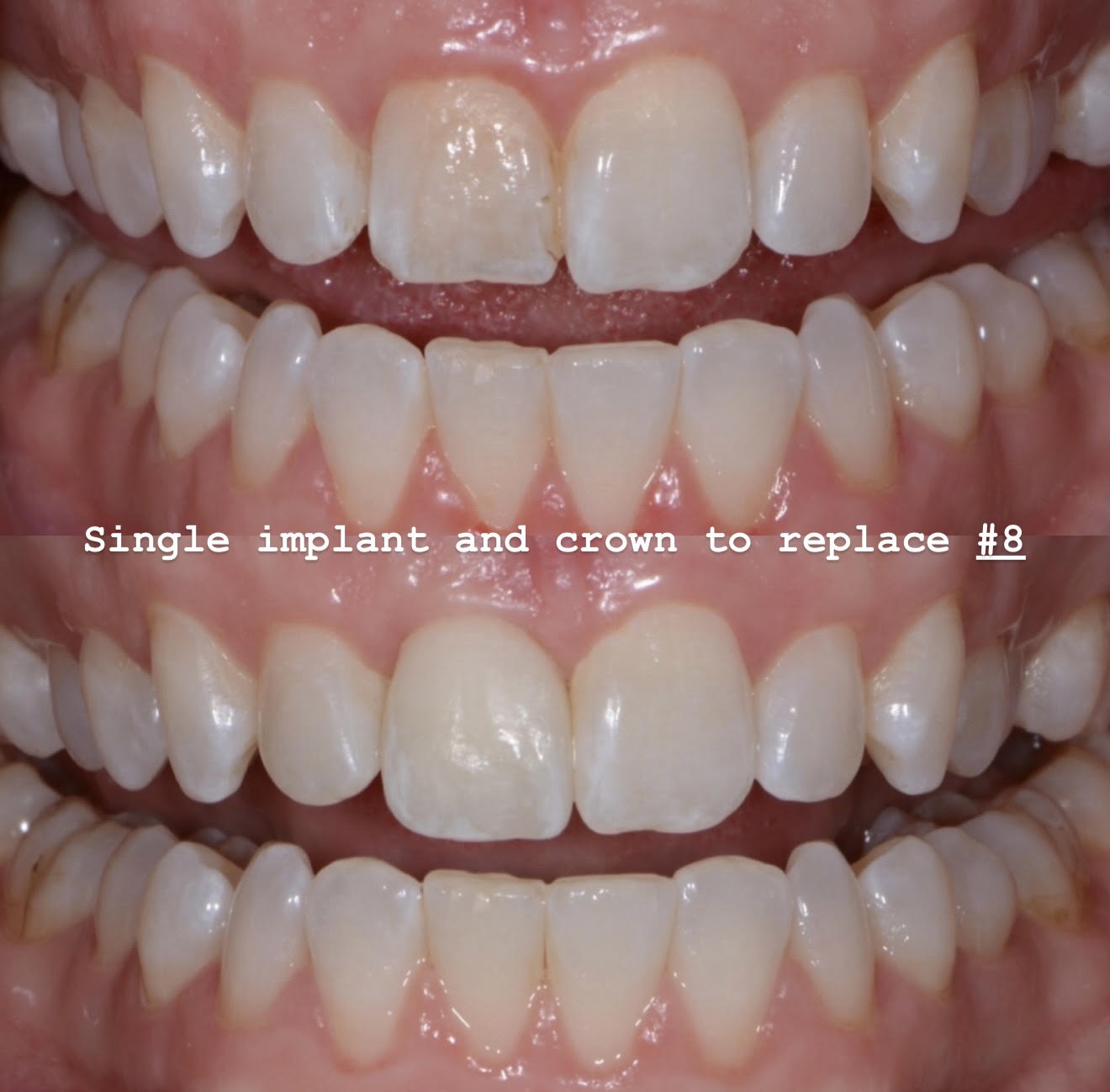 Single-tooth implant crown esthetic result