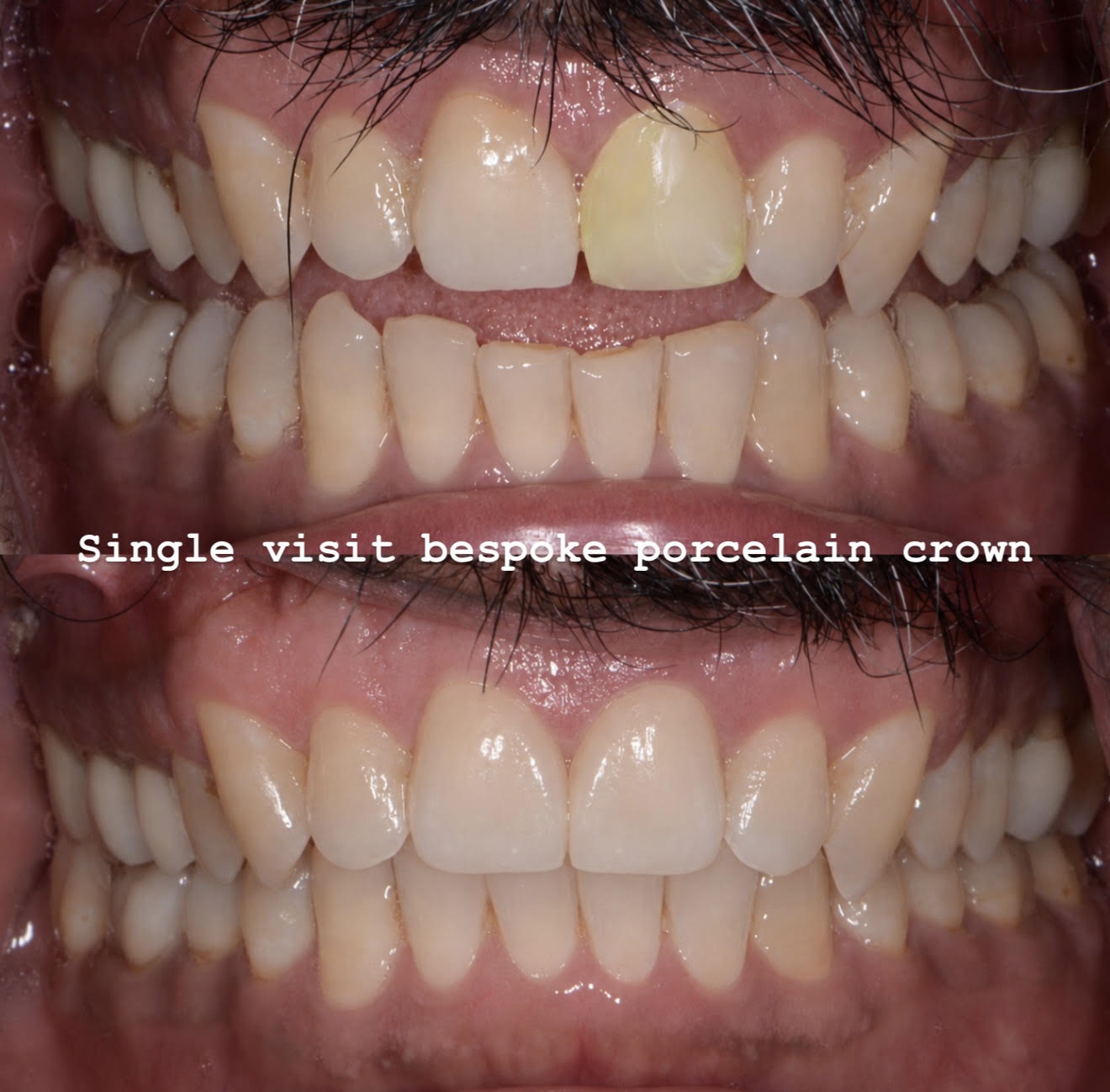 Single-visit bespoke porcelain crown