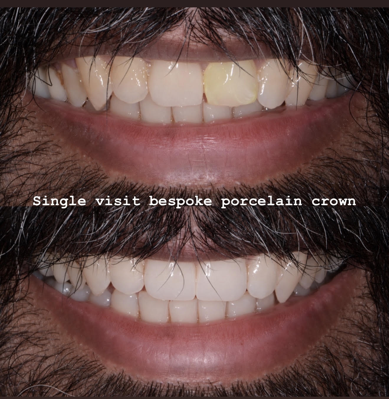 Single-visit bespoke porcelain crown smile restoration