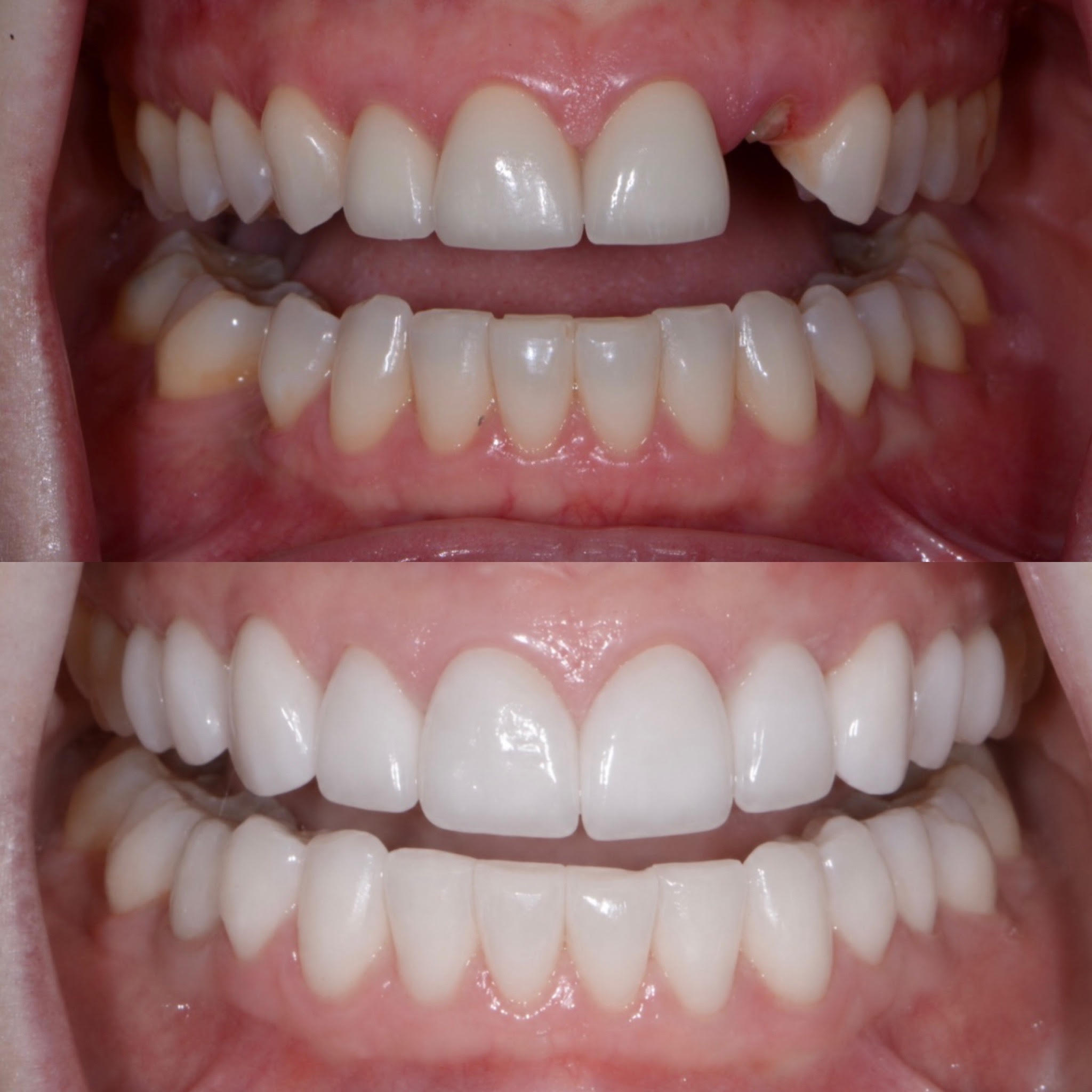 Full smile rehabilitation with an implant and cosmetic crown replacement