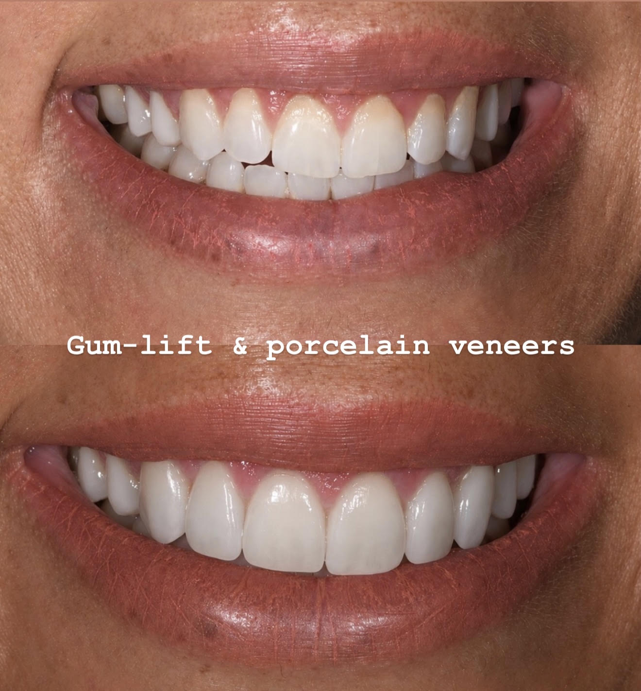 Gum lift and porcelain veneers
