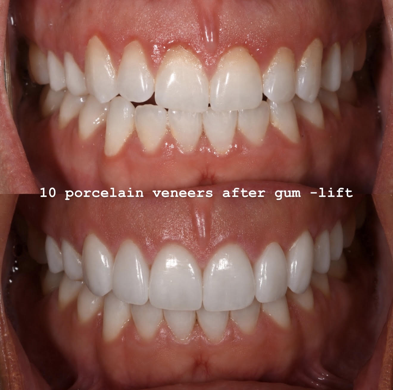 Ten porcelain veneers after gum lift