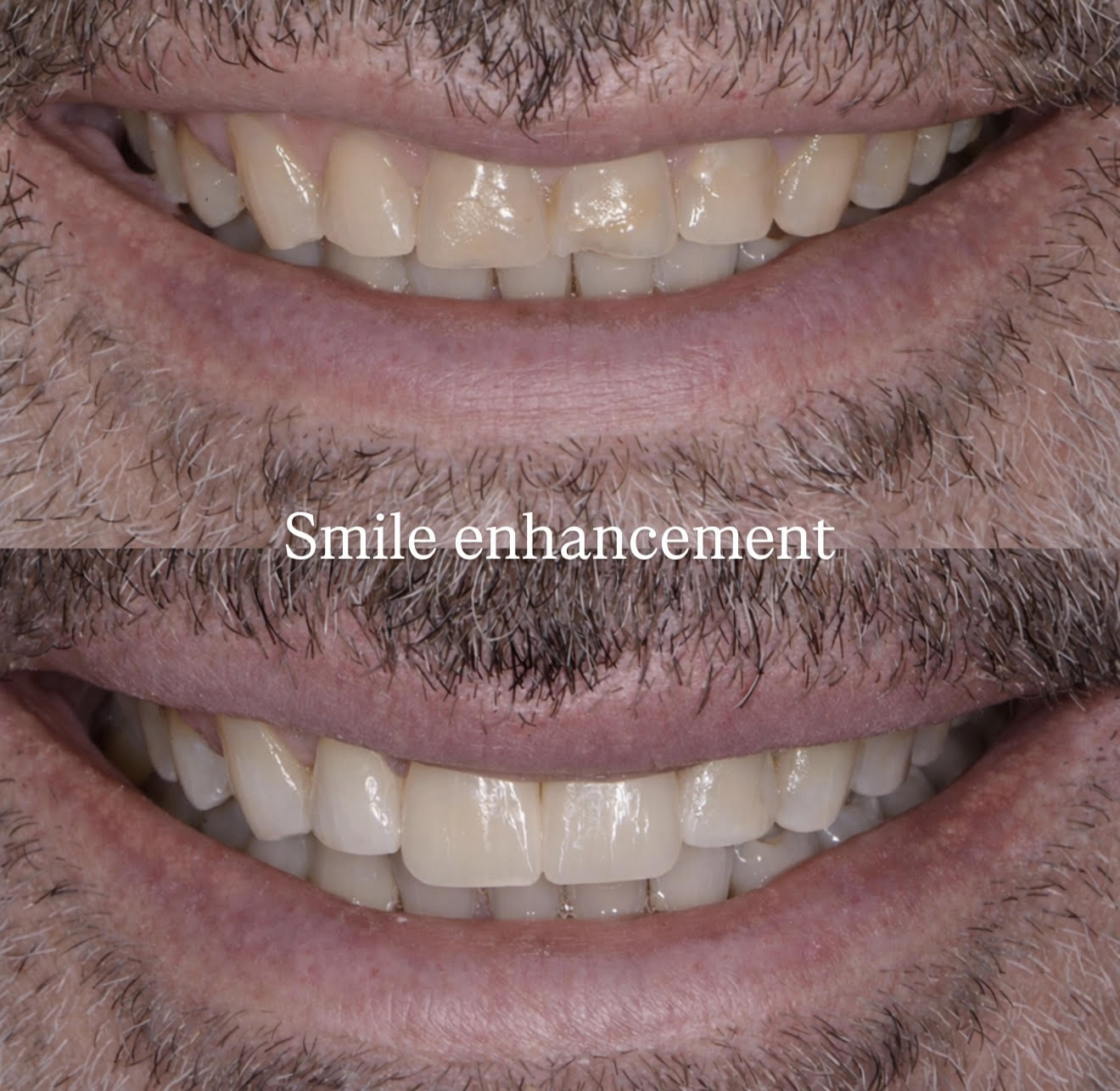 Smile Enhancement