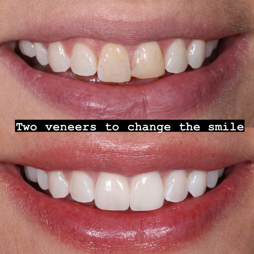 Veneers