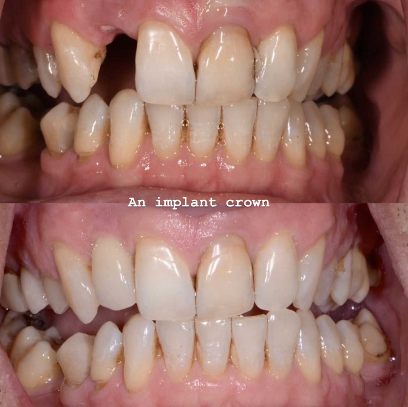 Before and after of a single esthetic implant crown blended into the patient’s natural smile