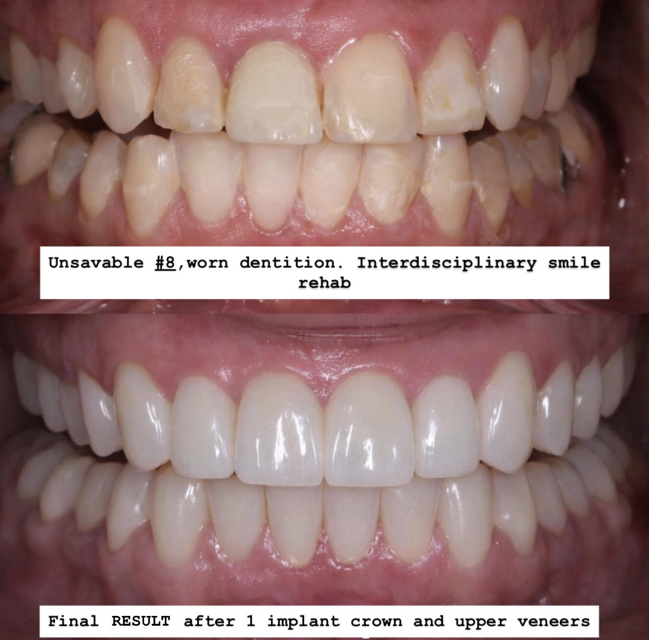 Worn Dentition Rehabilitation